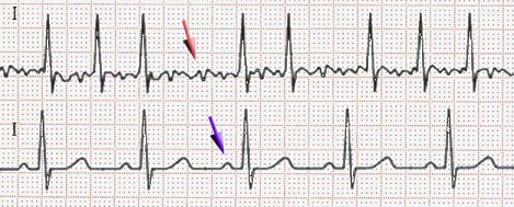 Sinus Arrhythmias- Atrial Fibrillation