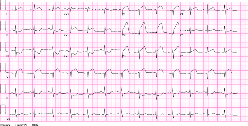 coronary artery disease ecg