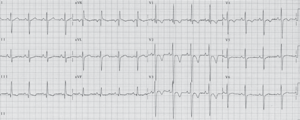 Right Ventricular Hypertrophy ECG (RVH ECG).