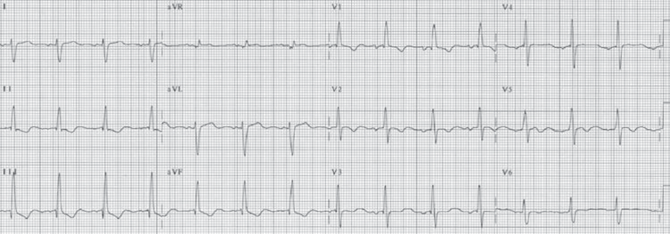 Right Ventricular Hypertrophy ECG (RVH ECG).