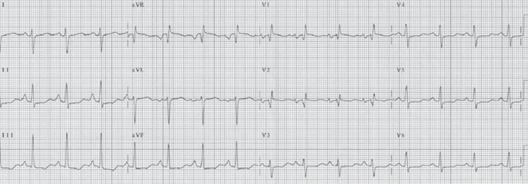 Right Ventricular Hypertrophy ECG (RVH ECG).