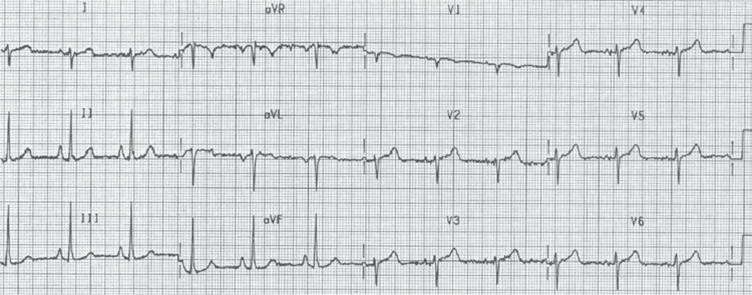 Right Ventricular Hypertrophy ECG (RVH ECG).