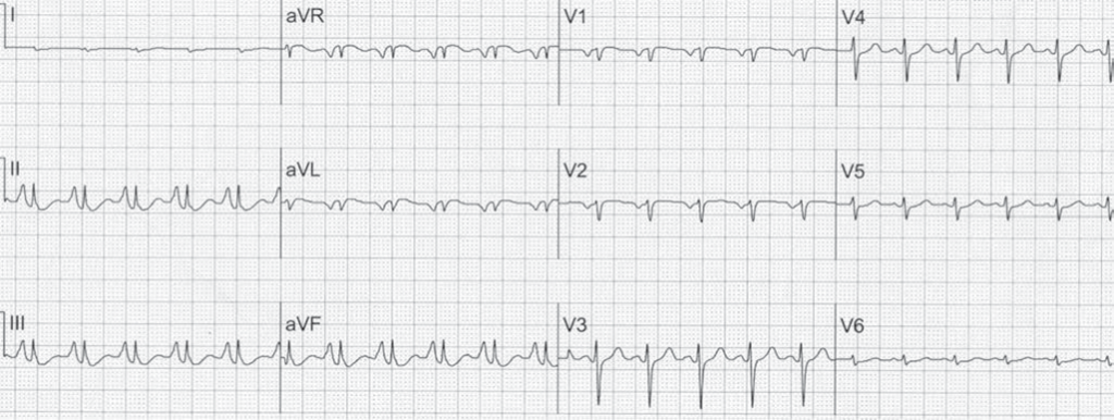 Right Ventricular Hypertrophy ECG (RVH ECG).