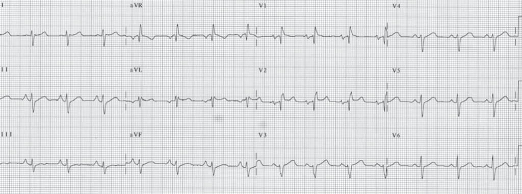 Right Ventricular Hypertrophy ECG (RVH ECG).