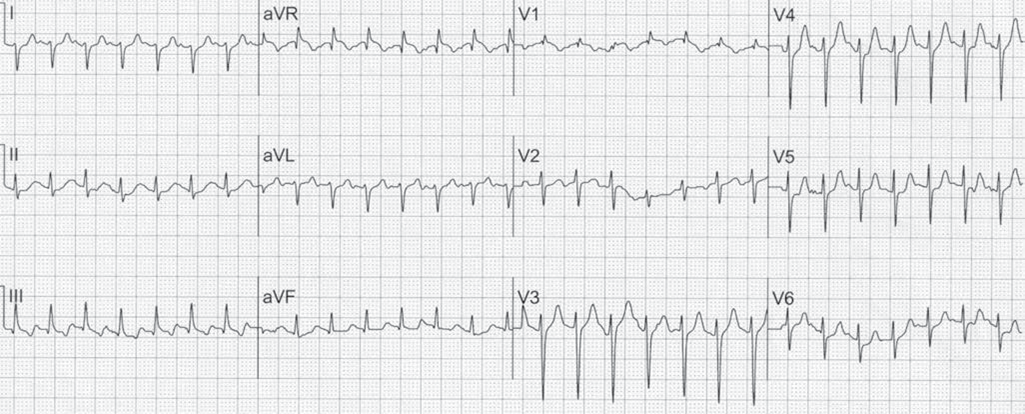 Right Ventricular Hypertrophy ECG (RVH ECG).