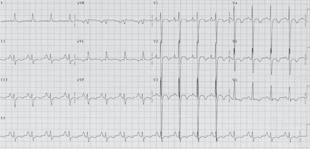 Right Ventricular Hypertrophy ECG (RVH ECG).