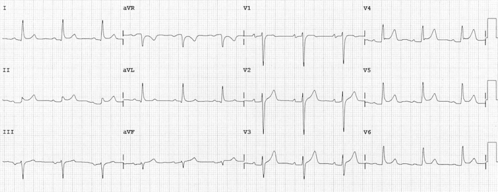 acute pericarditis ecg