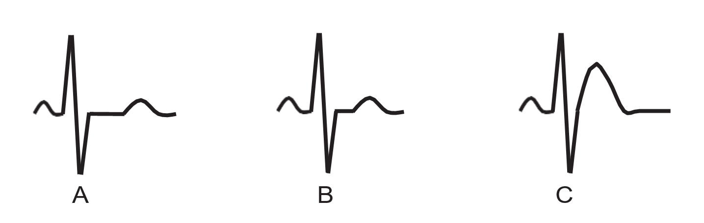 hypercalcemia