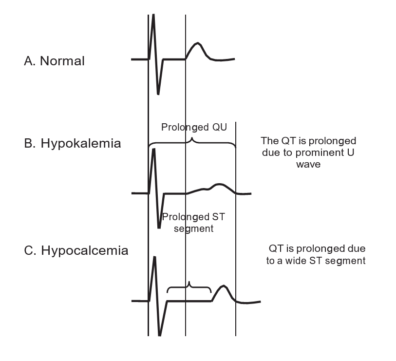 ecg in hypocalcemia