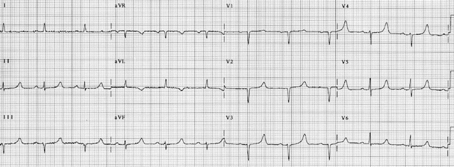ecg in hypocalcemia