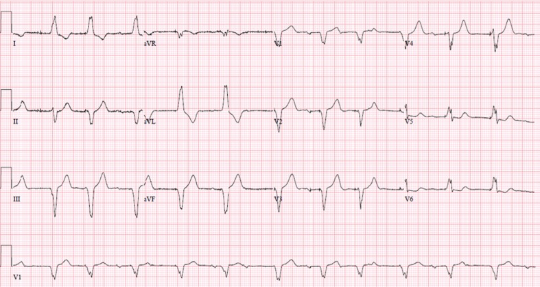 failure to capture in pacemakers