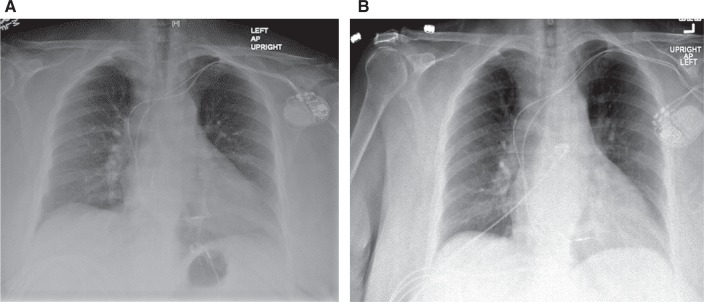 failure to capture in pacemakers