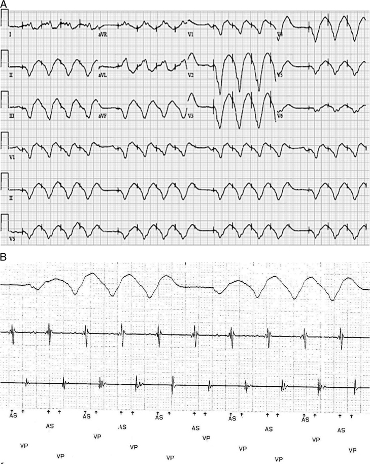 failure to capture in pacemakers