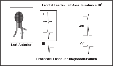 lafb- Left Anterior Fascicular Block